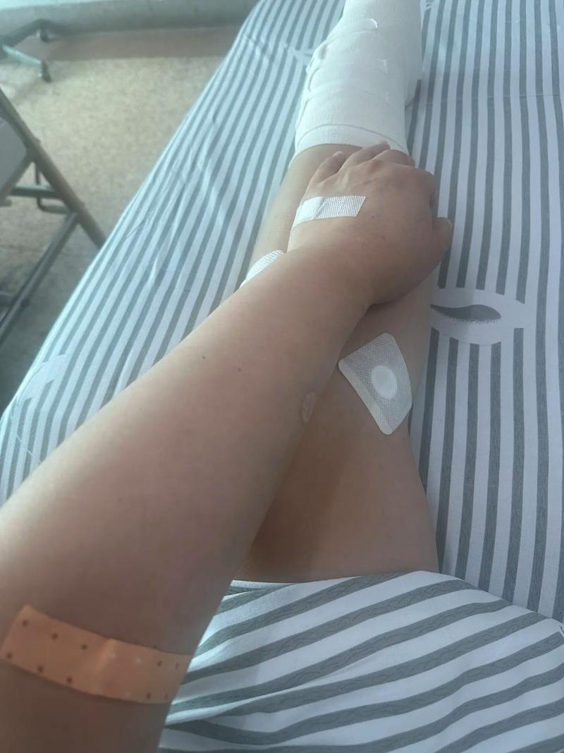 取钢板后多久能同房(取钢板后多久可以洗澡)