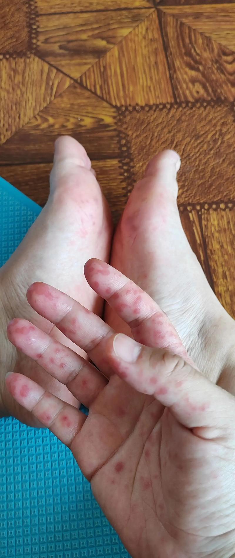 手足口有哪些症状(手足口有哪些症状表现)